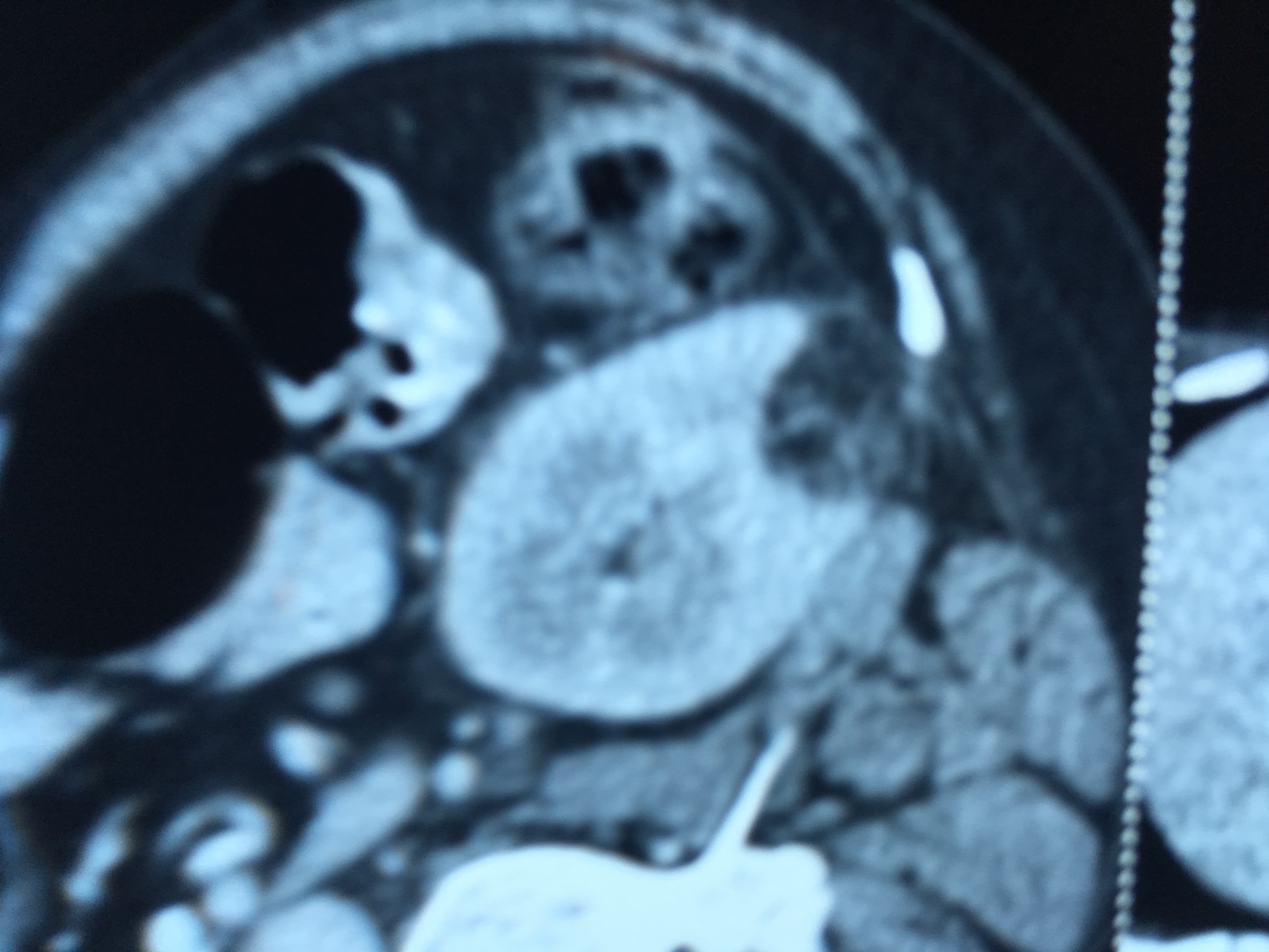 Angiomyolipoma Of Kidney- Incidental Finding